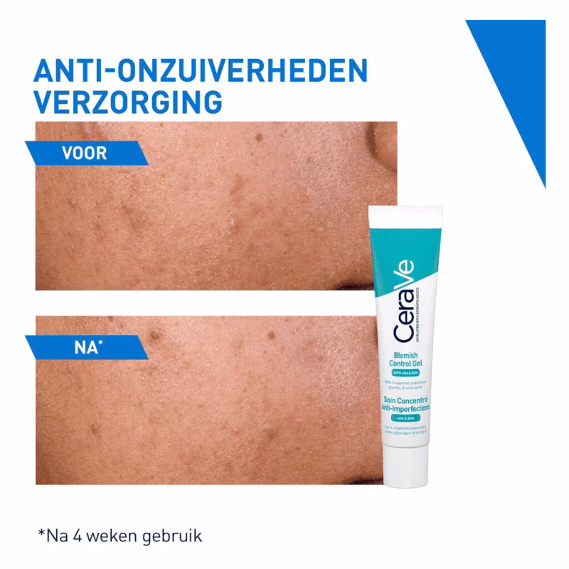 Hydrateer en verzorg je huid terwijl je acne aanpakt met CeraVe Acne Verzorgingscrème 40ml. Deze lichte crème vermindert onzuiverheden, ondersteunt het herstel van de huidbarrière en houdt de huid zacht en gehydrateerd. Verrijkt met ceramiden, niacinamide en hyaluronzuur voor een gezonde, gladde huid.